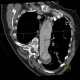 Aortic dissection, Standford B, dissecting aneurysm, re-entry: CT - Computed tomography